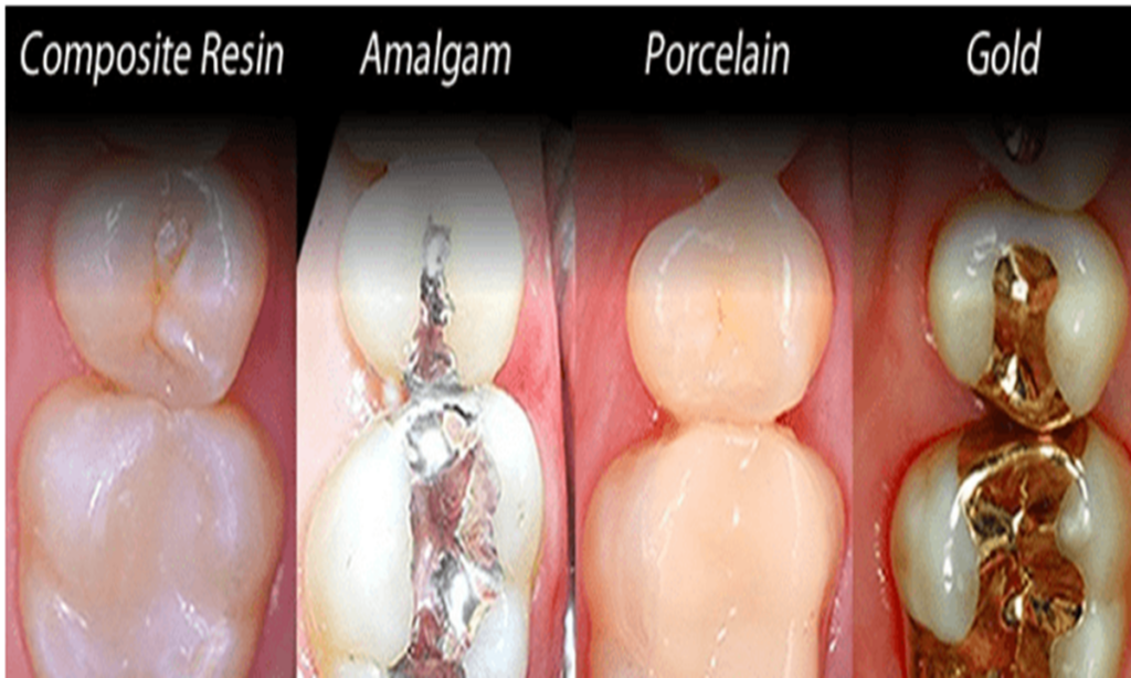 مواد مختلف پر کننده دندان