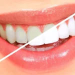 بلیچینگ دندان برای سفید کردن دندان ها