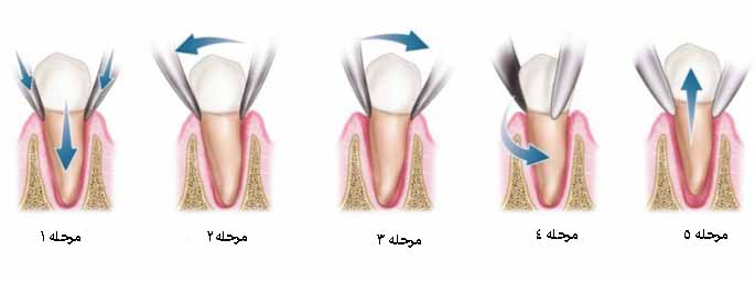 مراحل کشیدن دندان